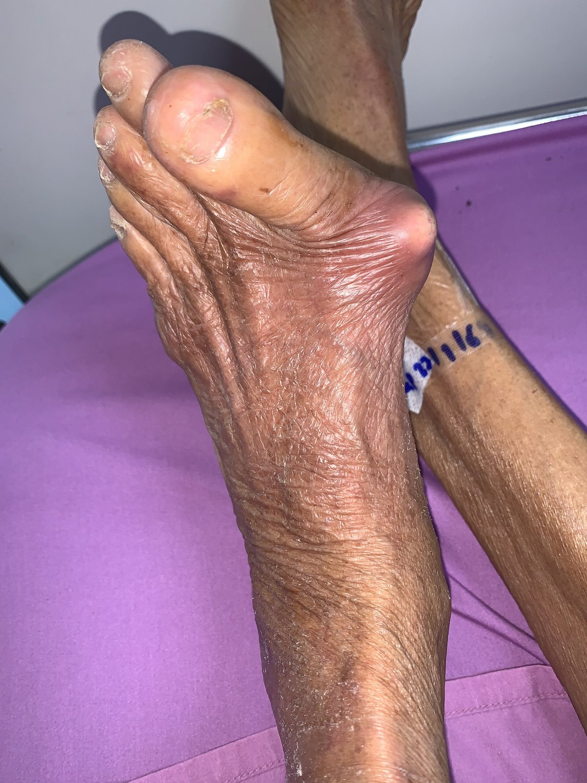 엄지발가락 뿌리 관절에 요산 덩어리가 쌓여 불룩하게 튀어나온 태국의 할머니 발입니다. 엄지발가락은 안쪽으로 휘어 있습니다 (사진: Chainwit., CC BY 4.0, 위키미디어 공용)