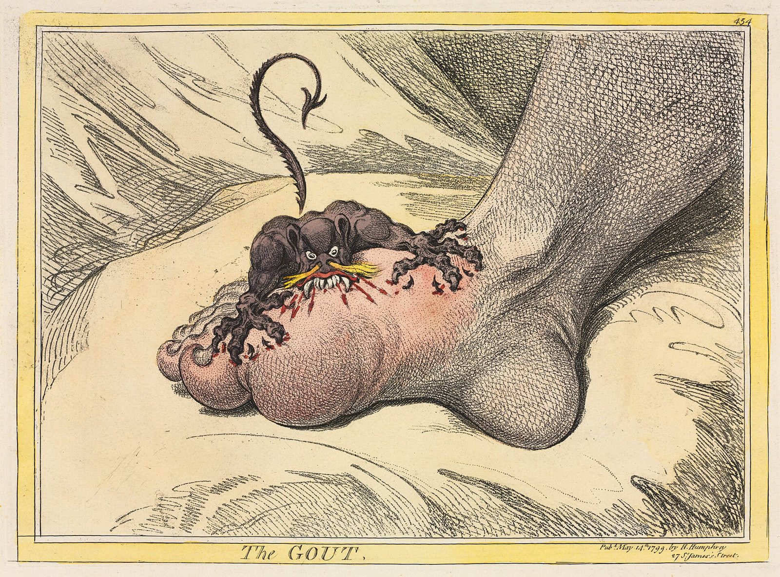 1799년 영국 화가 제임스 길레이가 그린 「통풍」입니다. 검은 괴물이 부어오른 엄지발가락을 물어뜯는 모습으로 통풍의 통증을 그렸습니다 (Cleveland Museum of Art, CC0, 위키미디어 공용)