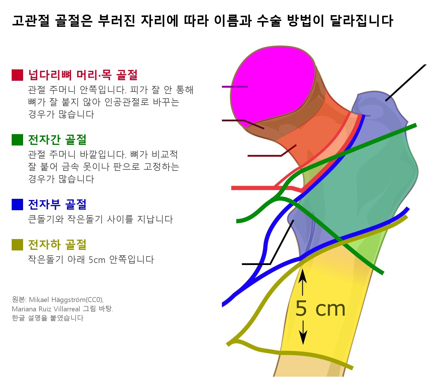고관절 골절은 부러진 자리에 따라 이름과 수술 방법이 달라집니다 (원본: Mikael Häggström, CC0, 위키미디어 공용. Mariana Ruiz Villarreal의 그림을 바탕으로 한 것에 한글 설명을 붙였습니다)