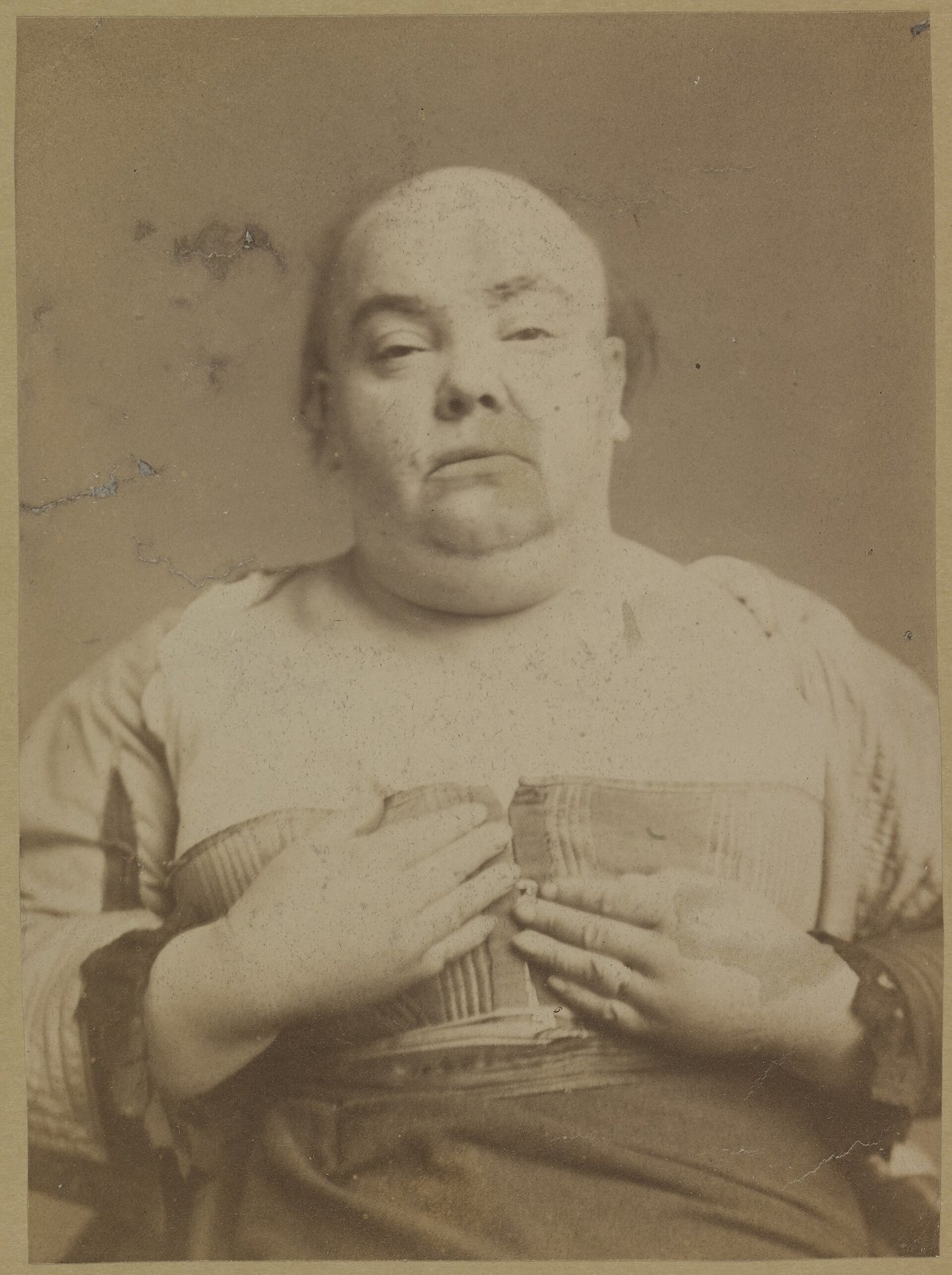 1885년 지금의 런던 동부 레이턴스톤에서 찍은 중년 여성의 사진입니다. 점액부종을 앓았고, 이 사진을 찍고 얼마 지나지 않아 세상을 떠났습니다 (사진: Wellcome Collection, CC BY 4.0, 위키미디어 공용)