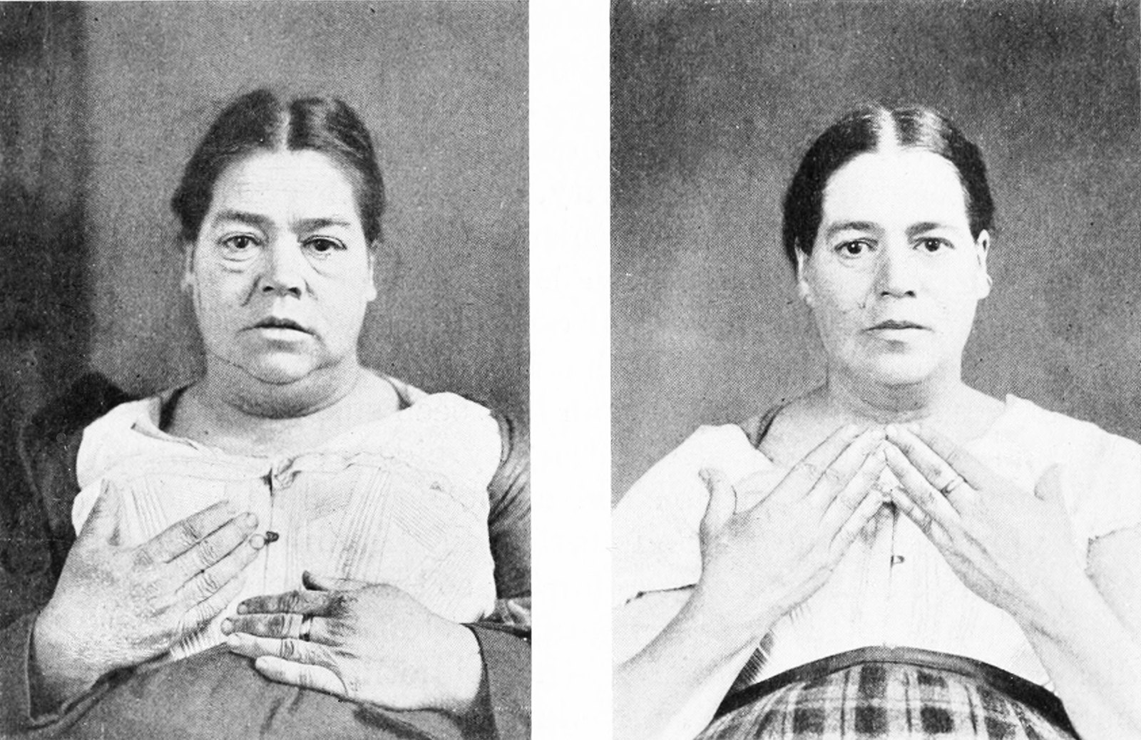 1897년 미국 과학 잡지에 실린 한 환자의 치료 전(왼쪽)과 치료 뒤(오른쪽) 사진입니다 (사진: Popular Science Monthly 제51권, 퍼블릭 도메인, 위키미디어 공용)