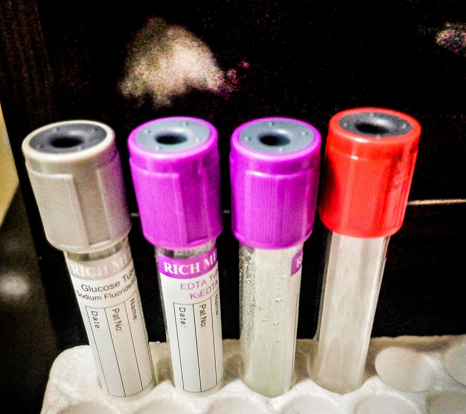 갑상선 검사는 피를 한 번 뽑아 TSH와 유리싸이록신 두 가지를 봅니다 (사진: Frankincense Diala, CC0, 위키미디어 공용)