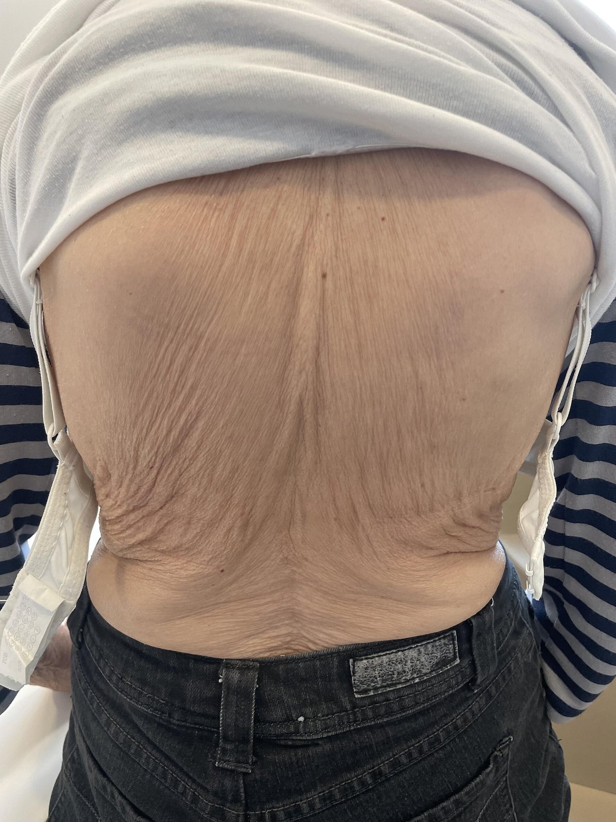 75세 여성의 등입니다. 척추가 눌려 몸통이 짧아지면서 등 피부가 비스듬하게 접혀 있습니다 (사진: Smartbyte, CC BY-SA 4.0, 위키미디어 공용)