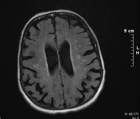 뇌 깊은 곳의 하얀 부분(백질)이 상한 노인의 뇌 MRI 사진입니다. 가운데 검은 공간 둘레로 희끗희끗하게 보이는 부분이 백질 변성입니다 (사진: Yakafaucon, CC BY-SA 3.0, 위키미디어 공용)